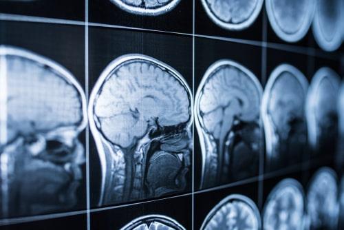 rockford brain injury lawyer